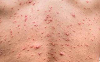 Тайланд сообщает о первой подозрении на новый штам обезьяньей оспы