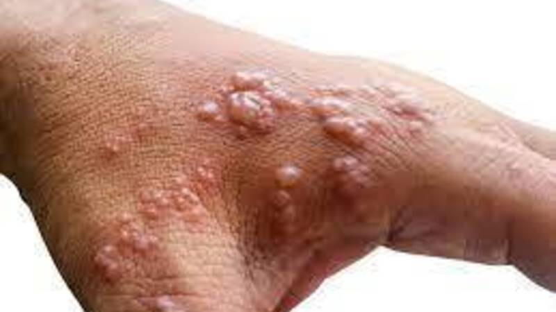 Заболевание обезьяньей оспой зарегистрировано в Бангкоке