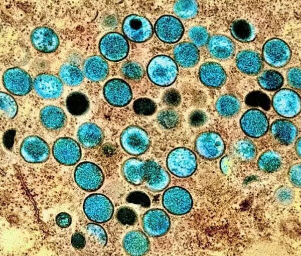 Первый подтвержденный случай обезьяньей оспы в Таиланде